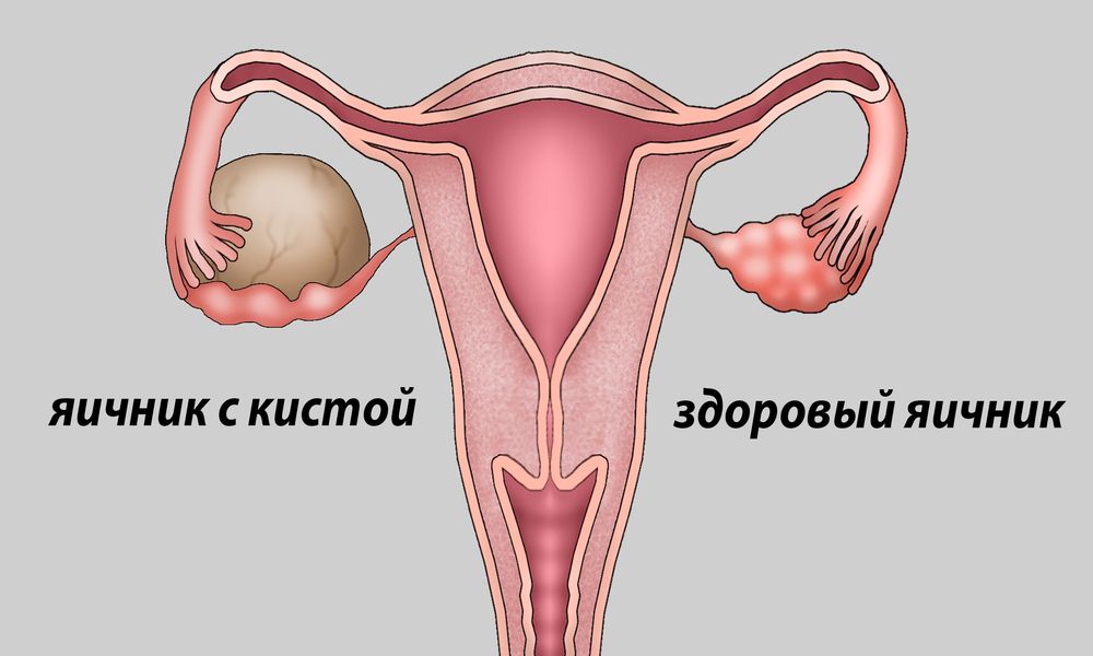 Параовариальная киста яичника лечение без операции