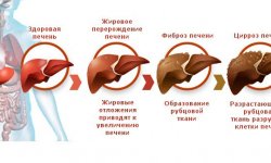 Цирроз печени: стадии болезни и выживаемость