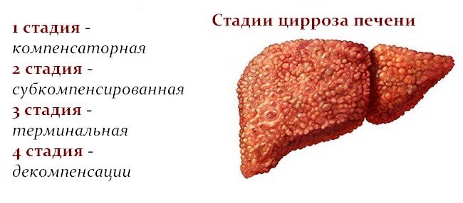 классификация цироза печени