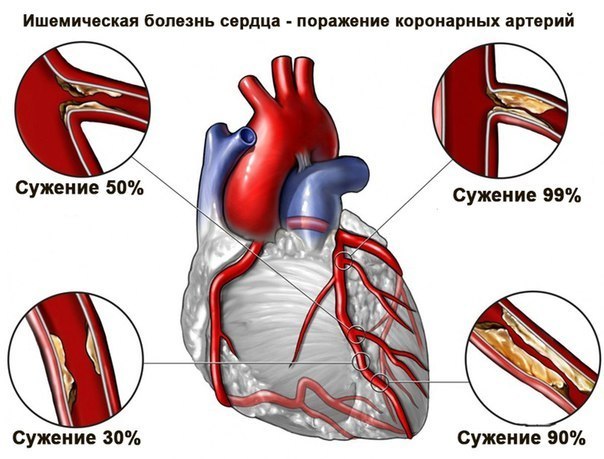 ишемическая болезнь сердца