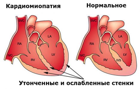 Инфаркт на фоне алкоголя